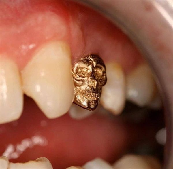 gold-crown-tooth-side-effects-goldtalkclub